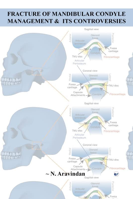 FRACTURE OF MANDIBULAR CONDYLE MANAGEMENT & ITS CONTROVERSIES [Paperback] N. Aravindan
